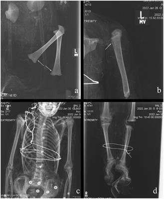 The “angioletti” of Palermo: the health and development of mummified non-adults in late modern Palermo, Sicily (1787–1880 CE)